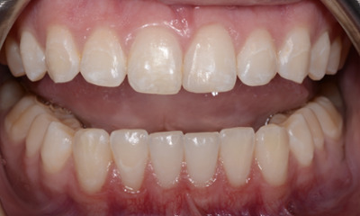 Composite-Filling-After-Image
