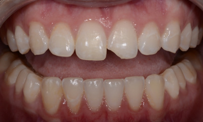 Composite-Filling-Before-Image